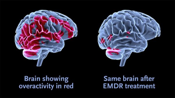 Emdr web illustration enlarged 1024x576